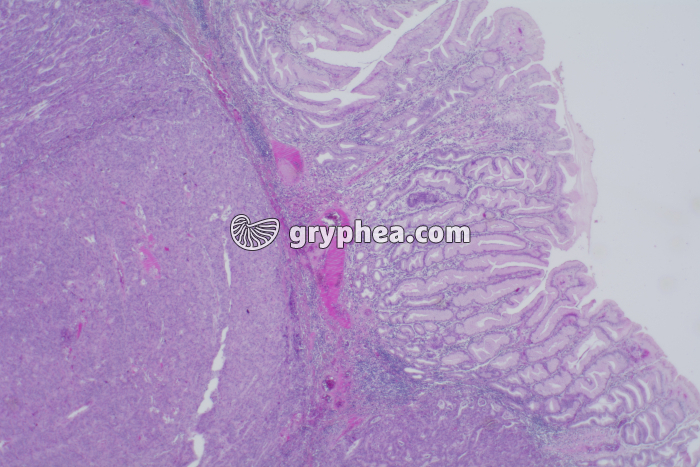 Cancer de l'estomac x10 - gryphea.org